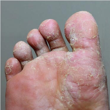 Athlete foot
