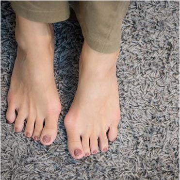 bunions